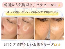 韓国大人気施術★ララピール★施術後の艶感がクセになる♪♪