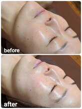 ウララ(ulala)/セラピールビフォアフ