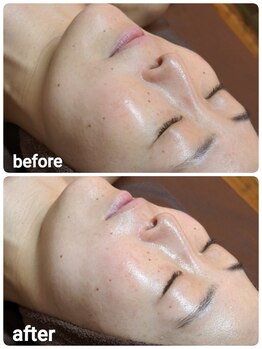 ウララ(ulala)/セラピールビフォアフ