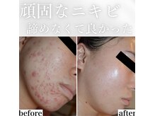 ホワイトアクア 鳳店(WHITE AQUA)の雰囲気（毛穴・ニキビケアに!芸能人御用達『REVIハーブピーリング）