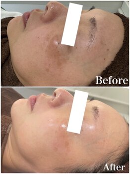 パールホワイトニングサロン 平塚店/トーンアップ/かんぱん集中ケア