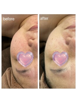 美温(mion)/インディバフェイシャル×ハーブ