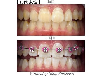 ホワイトニングショップ 静岡店/ホワイトニングBefore→After