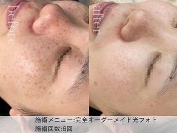 リエイト(Lieto)/完全オーメイド光フォト