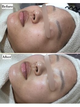 ソワナ(soina)/【神楽坂駅/フェイシャル/毛穴】