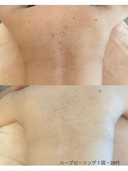 ボタニック 福津店(BoTANiC)/【ハーブピーリング】1回/20代