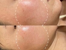 GRACETHOUSAND(グレイスサウザンド)/乾燥/ニキビケア/赤ら顔/敏感肌