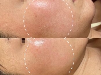 GRACETHOUSAND(グレイスサウザンド)/乾燥/ニキビケア/赤ら顔/敏感肌