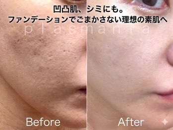 イノエ(inoe)の写真/【医療提携★】最新マシンプラズマニア導入サロン!細胞レベルのアプローチ+美容成分を浸透させ肌悩み解消！