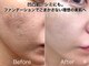 イノエ(inoe)の写真/【医療提携★】最新マシンプラズマニア導入サロン!細胞レベルのアプローチ+美容成分を浸透させ肌悩み解消！
