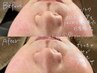 《3D毛穴ケア スタートコース》お肌状態をチェック！3D毛穴ケアですっきり！