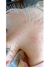 ハリキュア(Hari-Cure)/頑固なコリにルート鍼