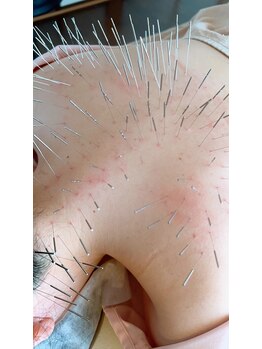 ハリキュア(Hari-Cure)/頑固なコリにルート鍼