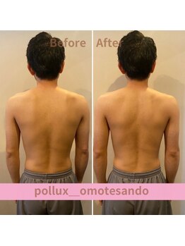 ポルクス鍼灸整骨院 表参道(Pollux鍼灸整骨院)/EMS ビフォーアフター