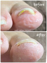 モストネイル 五日市店(MOST nail)/特許出願の巻き爪補正