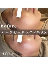 エピナ 千葉店(Epina)/全顔WAX＋ハーブピーリング☆