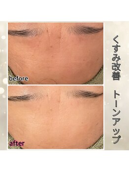 プルーム 久留米店(plume)/ハーブピーリング