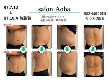 サロンアオバ 稲毛店(salon Aoba)/ビフォーアフター/脂肪冷却/痩身