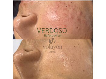 クレセント(crescent)/”ニキビケア”ならベルドソ管理