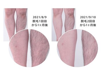 ヘルディン(heldin +555)/メンズ脱毛