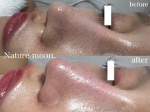 ナチュールムーン(Nature moon.)/毛穴洗浄