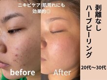 プルメリアの雰囲気（REVIハーブピーリング＃ニキビケア＃フェイシャル）