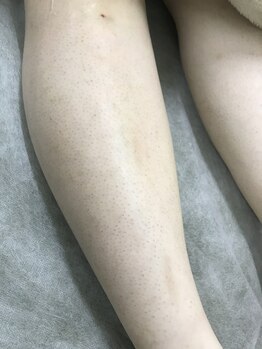 ナノハナ/鹿沼市本格脱毛の美容室ナノハナ