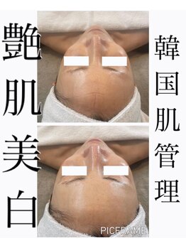 ジュエッテ(jouete)/圧倒的人気！水光白玉肌管理