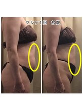 エクレボーテ(ECOULERBEAUTE)/マシンお腹　施術回数1回