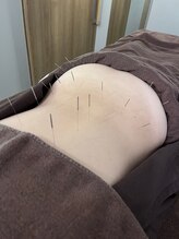 ハリマジック 代官山(HARI MAGIC)/【代官山/鍼灸/美容鍼】