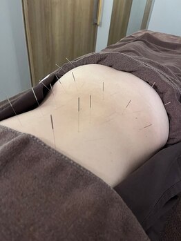 ハリマジック 代官山(HARI MAGIC)/【代官山/鍼灸/美容鍼】