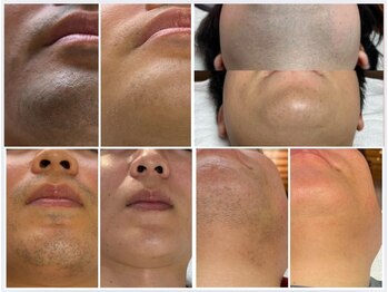 フェリス(FELIZ)/ヒゲ脱毛サロンを選ぶならFELIZ