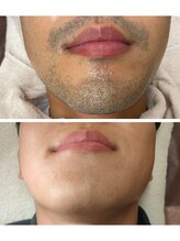 ロシェル(Rochell)/【ヒゲ脱毛】