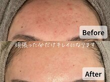 バタフライ 平塚店(Butterfly)/何年も悩んでいた赤み・肌荒れ