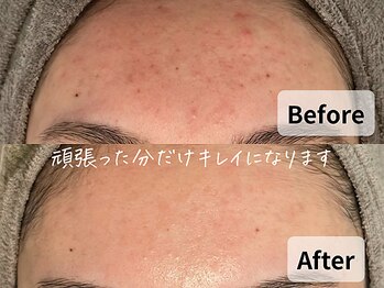 バタフライ 平塚店(Butterfly)/何年も悩んでいた赤み・肌荒れ