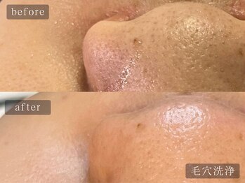 アムールサロン(Amour salon)/ハイドラ/毛穴洗浄/新宿/美肌