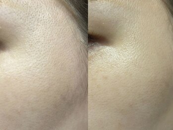 ドゥナ(DUNA)/韓国女優肌ピーリング