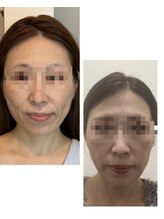 mano【小顔矯正/リンパマッサージ/筋膜リリース】/小顔矯正＋骨盤矯正