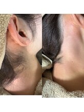 ルピナス(Lupinus)/うなじwax脱毛