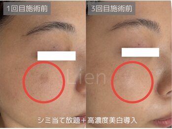 リアン/繰り返すシミ悩みに