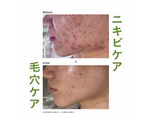 【フェイシャル・ハーブピーリング・よもぎ蒸し】EL spa中村橋【エルスパ】の雰囲気（こちらも大人気のクリスティーナで肌に優しいハーブピーリング　）