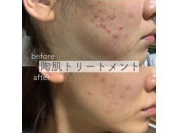 ルアナ(Luana)/ハーブピーリング