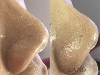 キャンディ 大阪梅田店(CANDi)/ハイドラピーリング/黒ずみ毛穴