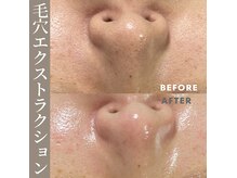 クリスティーナでプレミアムな毛穴ケア♪毛穴汚れやテカリ防止！