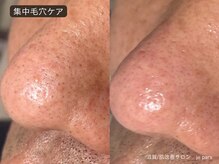 ジュパール(je pars)/毛穴エクストラクション