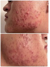 ケーフリー(K-free)/ハーブピーリング