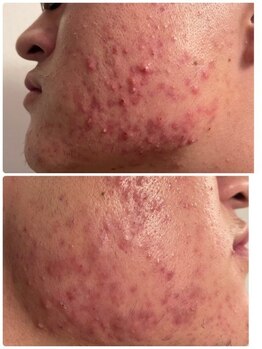 ケーフリー(K-free)/ハーブピーリング