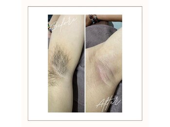 ラベニール(La Benir)/わき脱毛