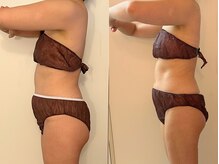 ヒールパーム(Heal Palm)/ウルトランスフォーマー1回★