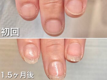 グラシュータン(gracieux temps)/【深爪矯正13000円】